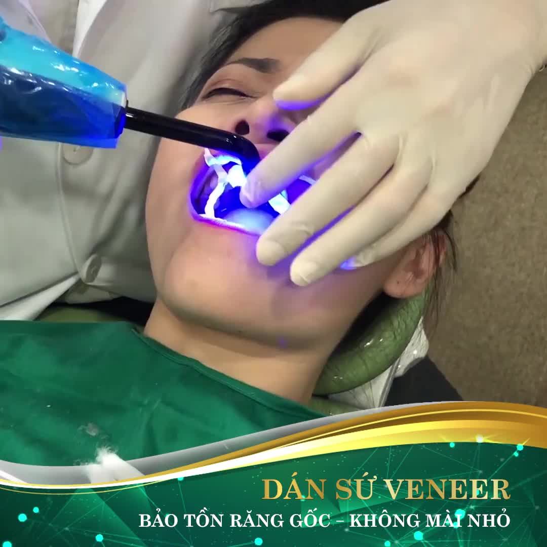 DÁN SỨ VENEER – KHÔNG MÀI NHỎ, KHÔNG ĐAU NHỨC, KHÔNG Ê BUỐT