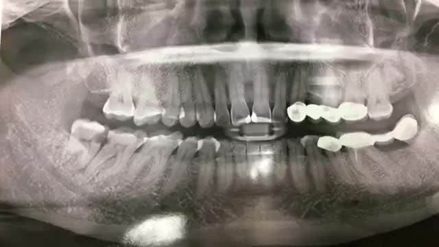 Nhổ răng khôn sâu đau nhiều lần cho cô Hiền.