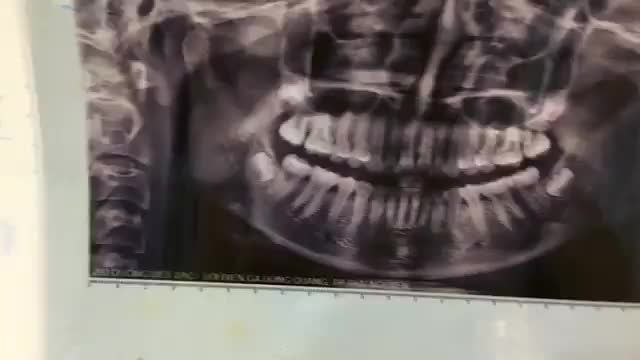 Nhổ răng khôn mọc ngầm cho bạn Thanh Trúc