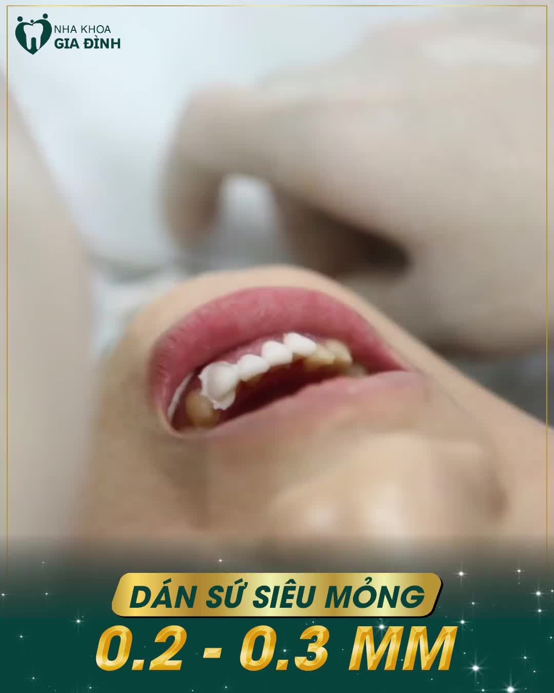 DÁN SỨ VÔ KHUẨN - ĐẸP CHUẨN AN TOÀN