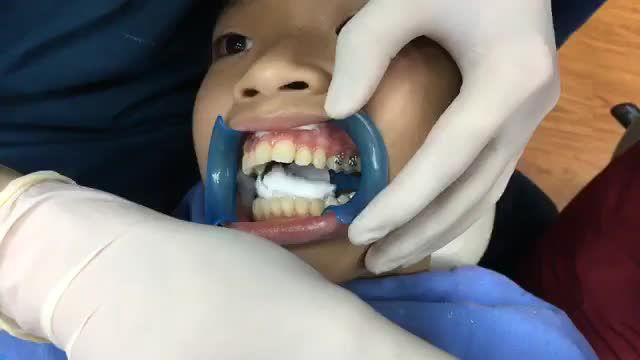 Gắn mắc cài chỉnh nha cho bạn Công 2005