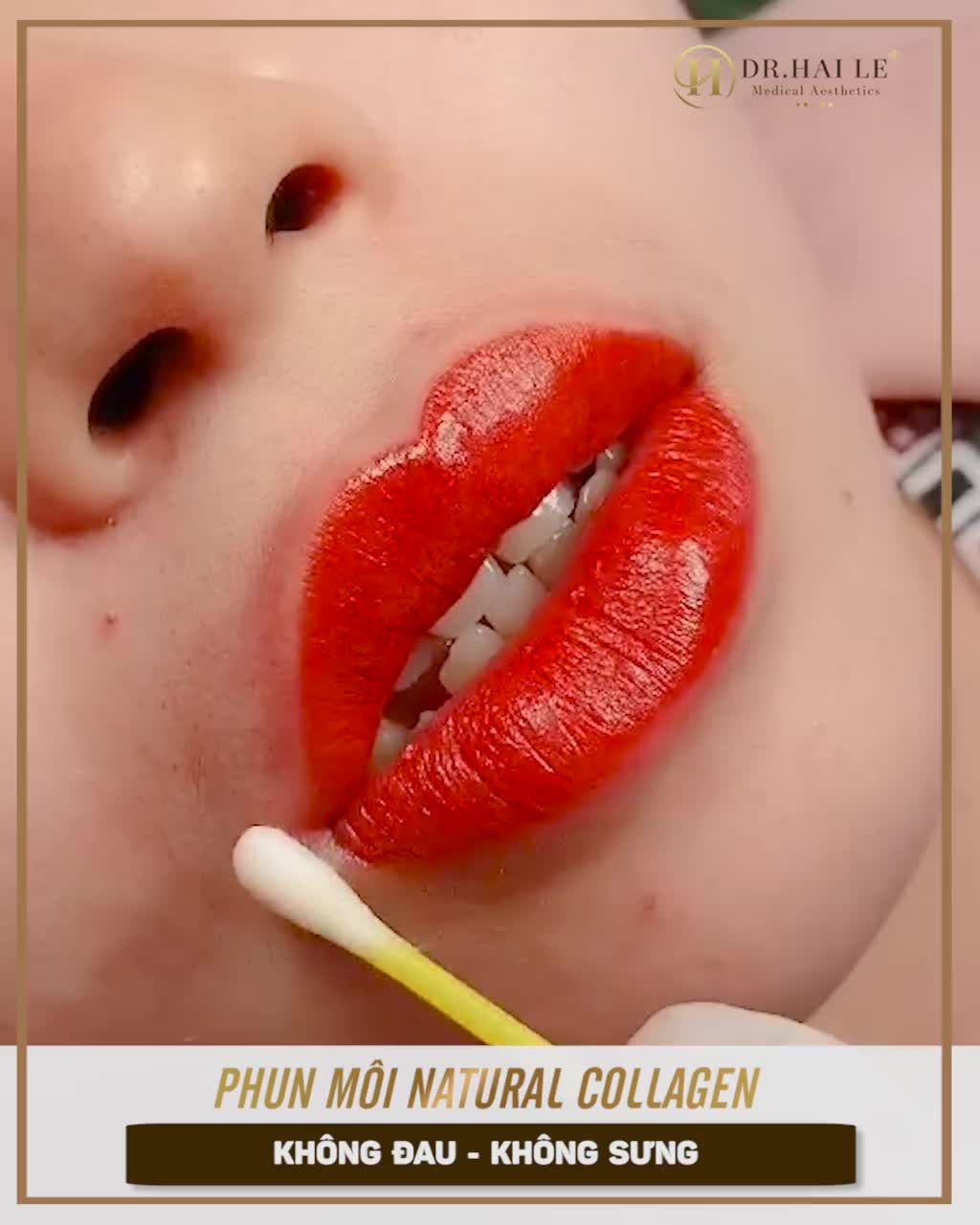 MÔI THÂM NHỢT NHẠT  THƯỜNG XUYÊN PHẢI SỬ DỤNG SON MÔI.