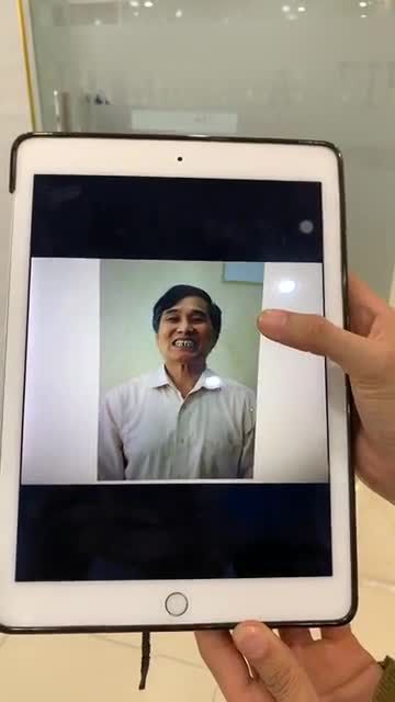 Case phục hình răng mất bằng phương pháp cấy ghép implant cho khách hàng hơn 10 năm sử dụng hàm giả tháo lắp