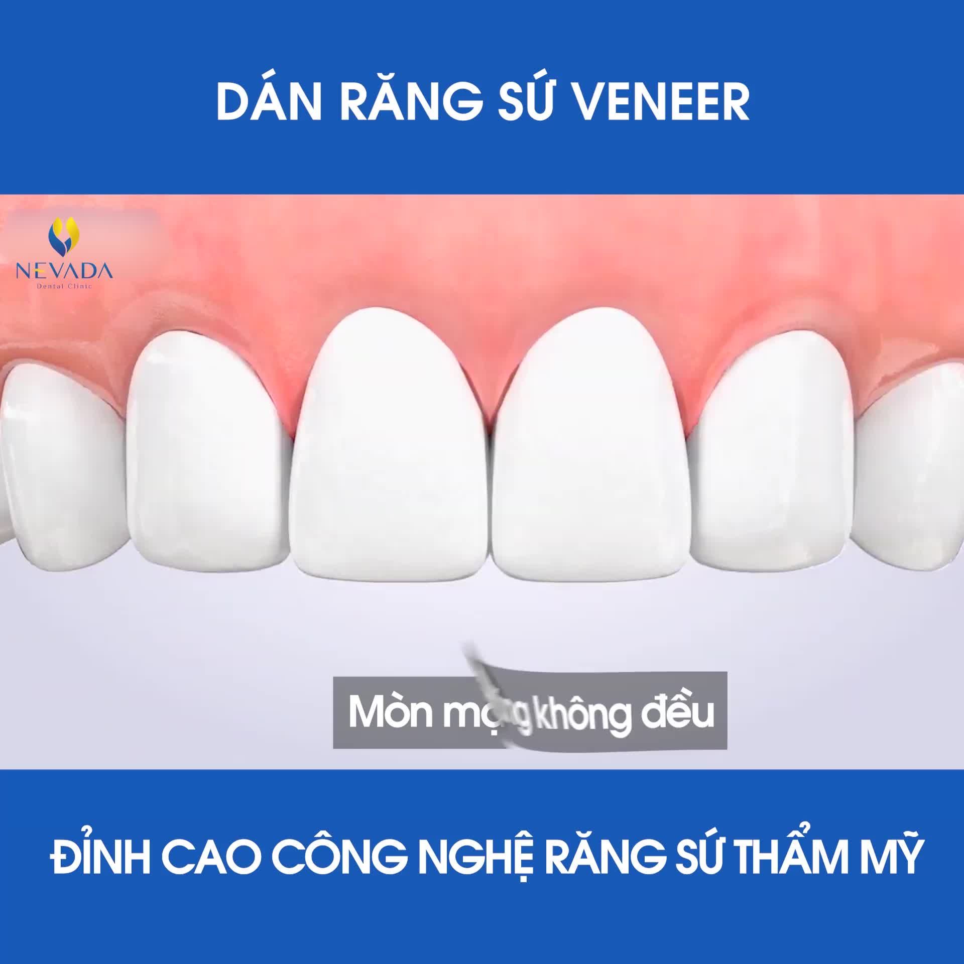 DÁN SỨ VENEER - ĐỈNH CAO CÔNG NGHỆ RĂNG SỨ THẨM MỸ