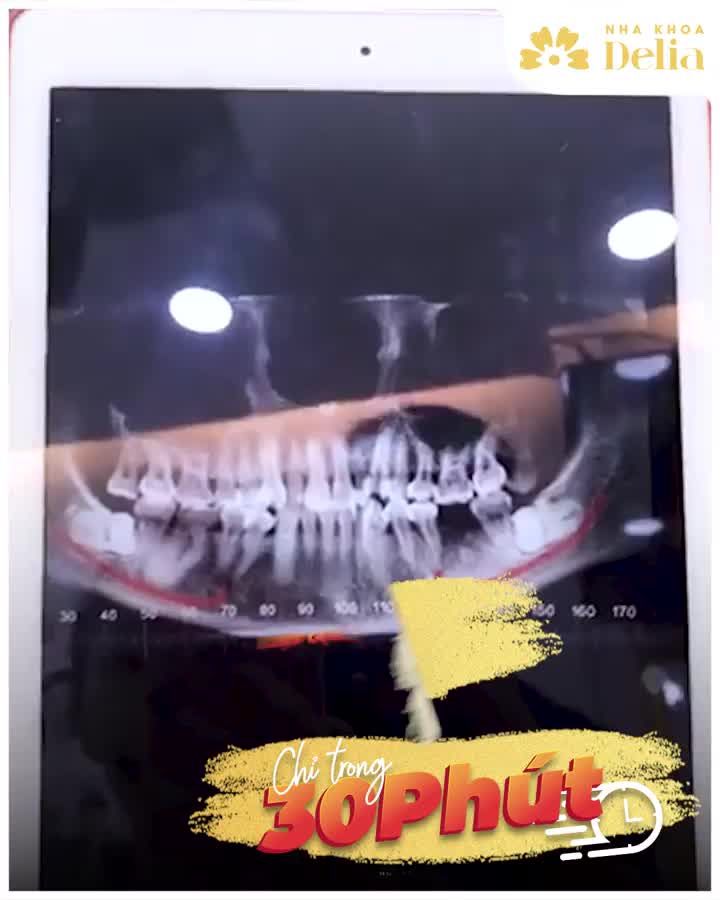 Diệt gọn 4 chú răng khôn mọc ngang, chân răng cong chỉ trong 30 PHÚT - KHÔNG ĐAU - KHÔNG SƯNG bằng công nghệ nhổ răng siêu âm PIEZOTOME.