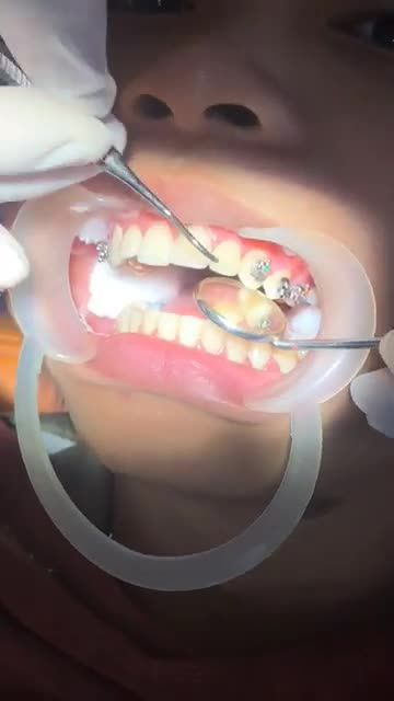 GẮN MẮC CÀI NIỀNG RĂNG ĐIỀU TRỊ RĂNG HÔ - CẮN SÂU tại Nha Khoa Vân Anh