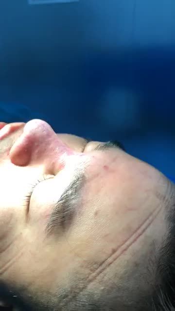 Nâng Mũi Bán Cấu Trúc Sụn Tai 2 Lớp dáng Lline cao tây đẹp hoàn hảo sau 45 phút