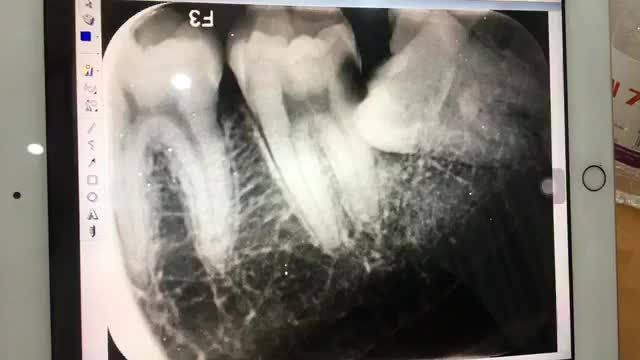 Nhổ răng khôn mọc lệch 90 độ đâm hỏng răng 7 cho anh Tùng.