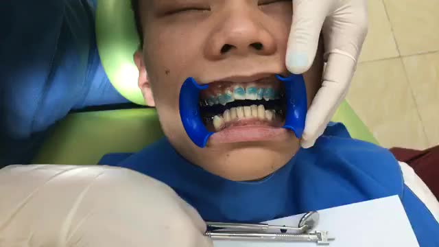 Gắn mắc cài bắt đầu một quá trình niềng răng tại Nha Khoa Thuỳ Anh.