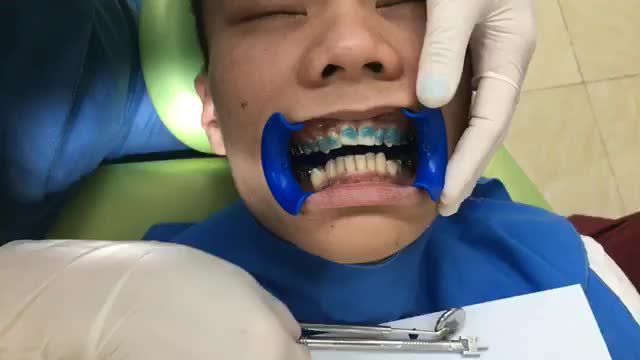 Gắn mắc cài bắt đầu một quá trình niềng răng tại Nha Khoa Thuỳ Anh.