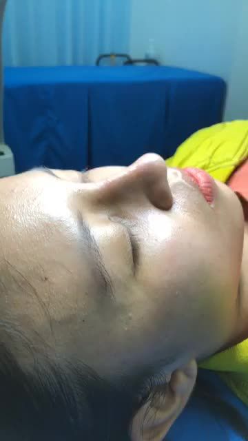 Tái khám tháo nẹp Nâng Mũi Bán Cấu Trúc Đa lớp + Cuộn cánh mũi Plasma Đẹp hoàn hảo sau 10 ngày
