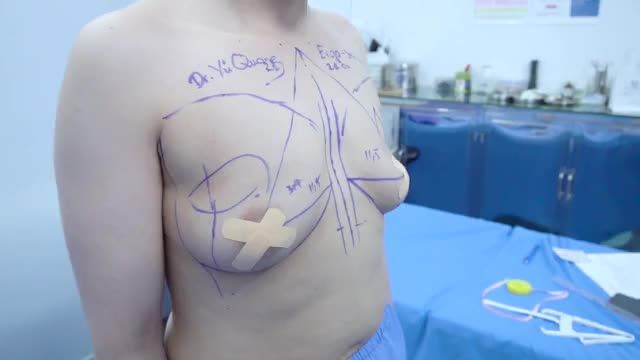Ekip Dr Vũ Quang bắt đầu ngày mới với Ca nâng Ng ực sau sinh.