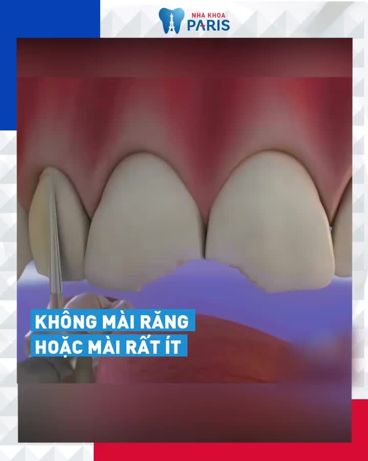 DÁN SỨ VENEER SIÊU MỎNG  THAY "ÁO MỚI" CHO RĂNG