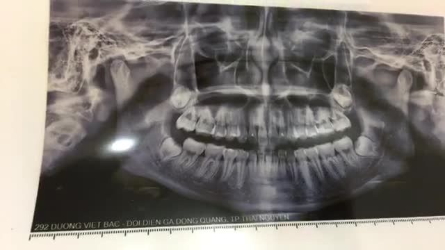 Nhổ răng 8 mọc ngầm cho bạn Thu Hương tại Nha Khoa Thùy Anh.