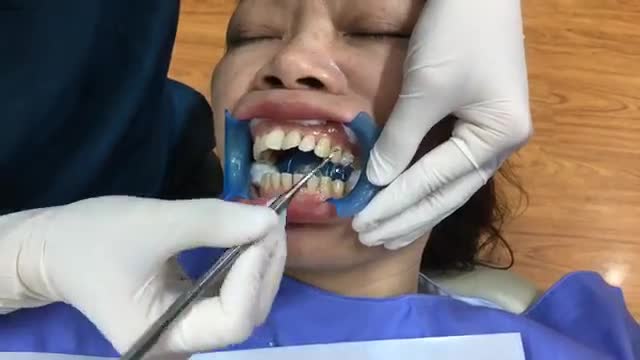 Gắn mắc cài chỉnh nha cho chị Dung