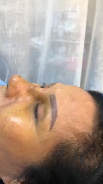 Nâng mũi Bán Cấu Trúc Sụn Tai 2 Lớp sau 7 ngày tháo nẹp Dang Lline kết Sline cao tây sang chảnh