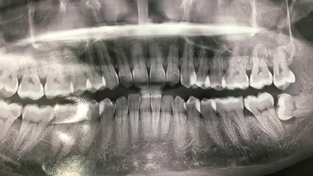 Nhổ răng khôn mọc ngầm lệch 90 độ cho anh Nghĩa tại Nha Khoa Thuỳ Anh.