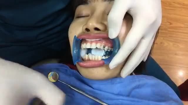 Gắn mắc cài chỉnh nha cho ban Yên tại Nha Khoa Thùy Anh.