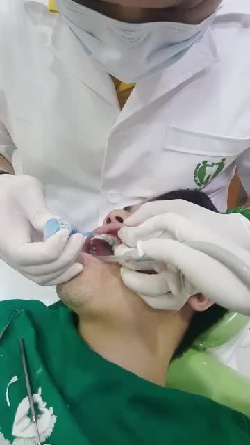 Case dán 18 Veneer Ultrathin - KH Mạnh Hùng tại phòng khám vô trùng của Nha khoa Gia Đình.