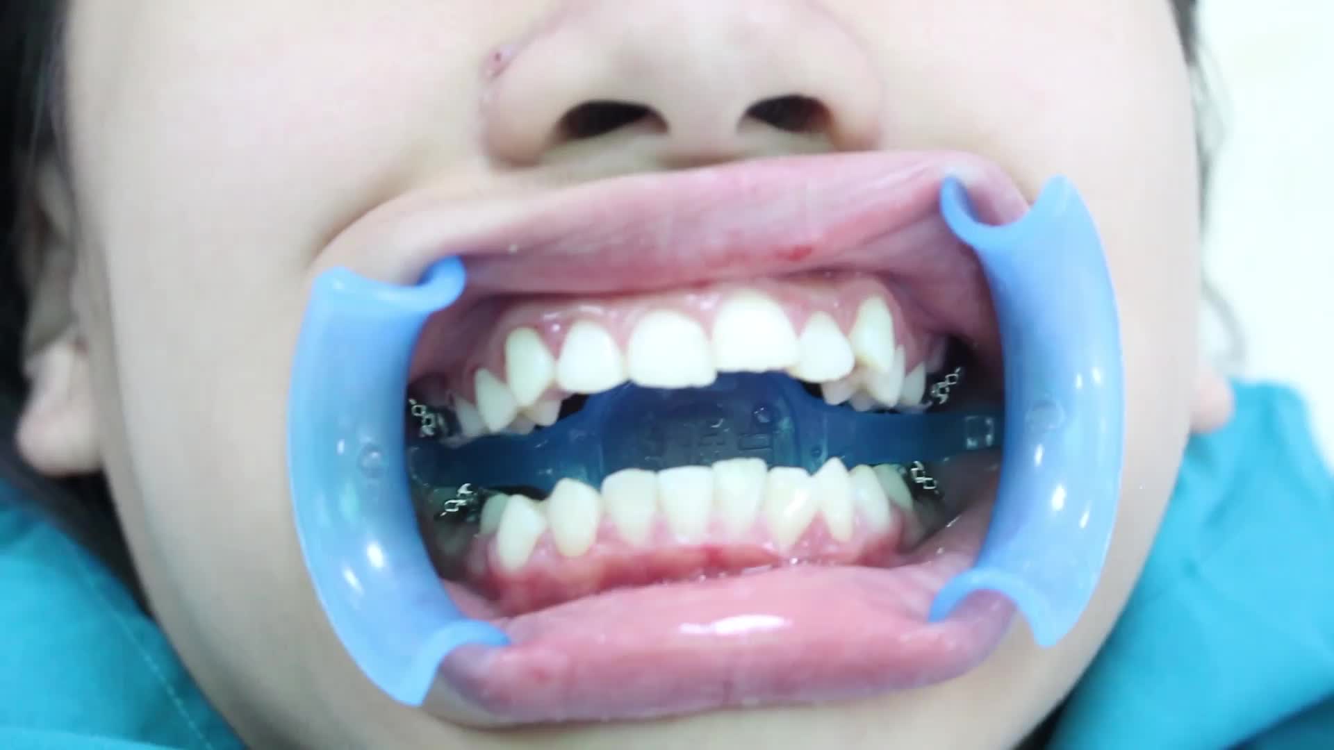Case gắn mắc cài kim loại thông minh 3M Mỹ cho bệnh nhân N.V.A - 15 tuổi Gia Lâm.