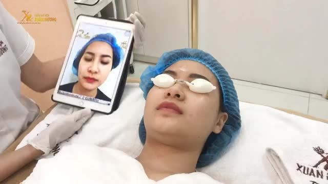 DA CĂNG BÓNG TỰA PHỦ SƯƠNG SAU KHI TRẺ HÓA DA BABY FACE