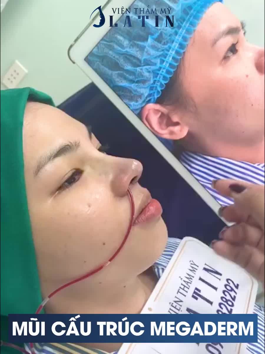 MŨI CẤU TRÚC MEGADERM THAY ĐỔI HẲN KHUÔN MẶT