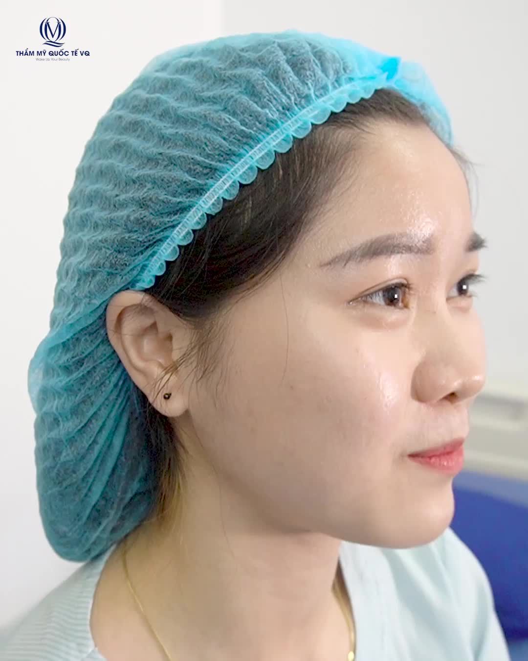 NÂNG MŨI SOFTLINE CHỈ 8,6 TRIỆU