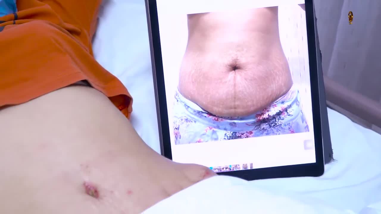 Nếu các chị em gặp phải tình trạng bụng xổ sau sinh, da bụng rạn, sạm và chùng nhão nhiều, ... thì không có phương pháp cải thiện nào tốt hơn tạo hình thành bụng đâu ạ!
