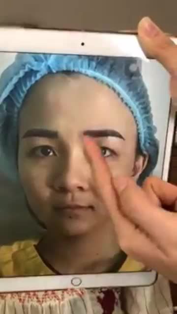 Siêu combo làm đẹp "quyền lực" Nâng mũi + Cắt mí + Treo cung mày đã thay đổi hoàn toàn nhan sắc của khách hàng tại Dr.Hải Lê!