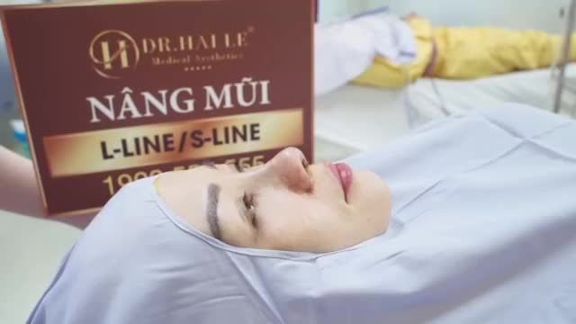 Thật bất ngờ hình ảnh khách hàng xinh đẹp sau nâng mũi S-line kết hợp thu nhỏ cảnh mũi