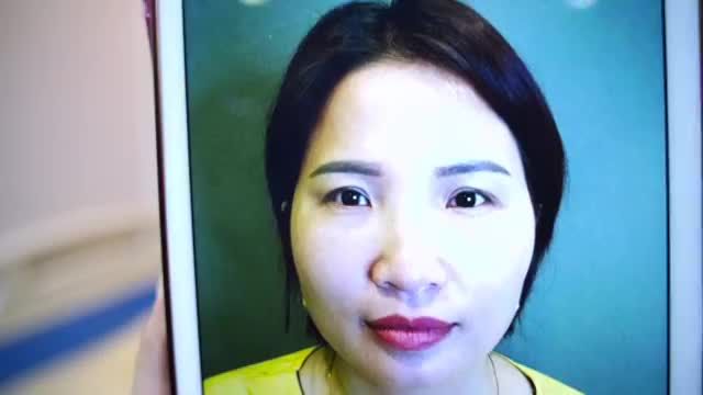 Cắt mí chuẩn Dr.Hải Lê - Mí đều - Mắt to tròn- Tự nhiên