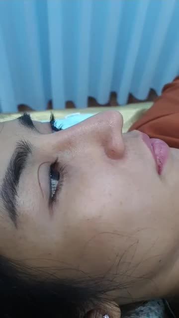 Nâng mũi cấu trúc đa lớp Dáng Lline cao tây Quá đẹp sau 8 tháng