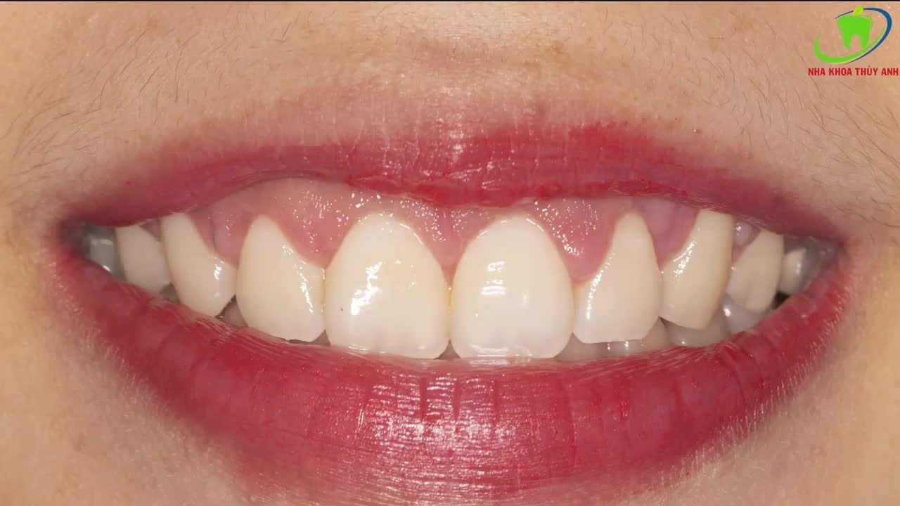 SMILE DESIGN BIẾT TRƯỚC KẾT QUẢ ĐIỀU TRỊ CƯỜI HỞ LỢI