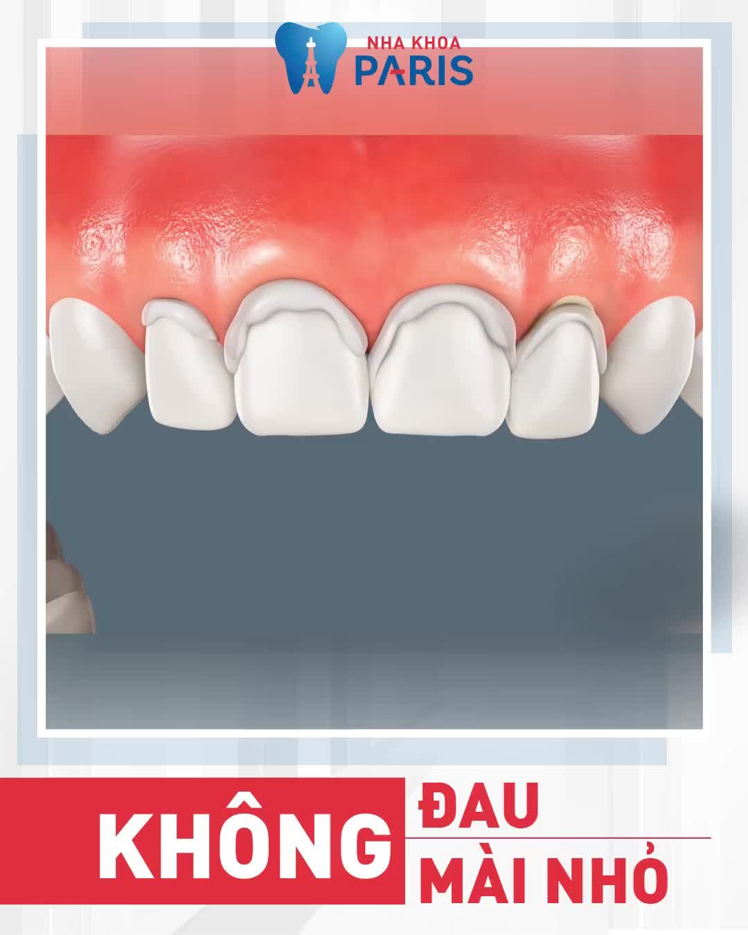 BỌC RĂNG SỨ GIÁ TỐT NHẤT NĂM