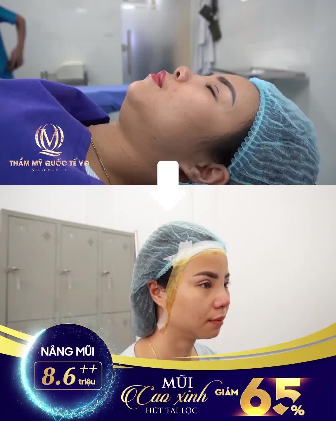 Combo Nâng mũi SOFTLINE + Mí BABY EYE 6D của chị khách hàng xinh đẹp vừa xong