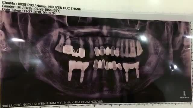 Cấy chân răng nhân tạo số 4 cho chú Thành. Tại Nha Khoa Thuỳ Anh.