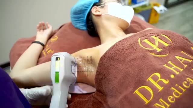 Thoát khỏi mồ hôi giúp cho vùng da dưới cánh tay thoải mái và khô thoáng nhờ công nghệ MiraDry.MiraDry - Công nghệ số 1 trong điều trị tăng tiết mồ hôi và hôi nách