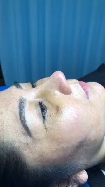 Tái khám nâng mũi Bán Cấu Trúc Sụn Tai 2 Lớp sau 10 ngày