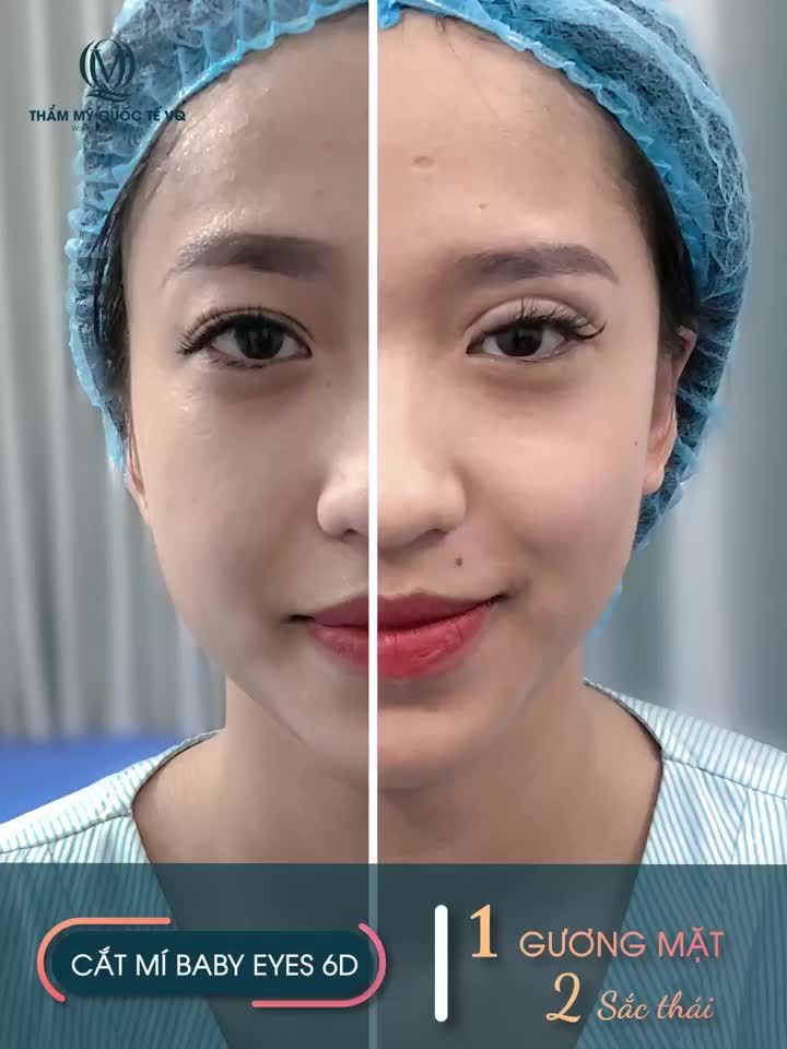 TRẺ HƠN, THẦN THÁI HƠN VỚI CẮT MÍ BABY EYES 6D