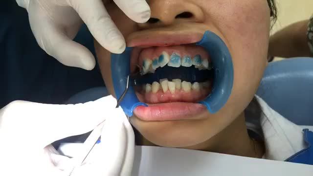 Gắn mắc cài chữa lệch lạc nặng cho bạn Ngọc Ánh.
