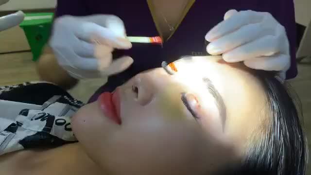Quá trình cắt chỉ com bo nâng mũi và cắt mí sau 9 ngày.