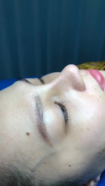 Tái khám cắt chỉ sau 10 ngày.