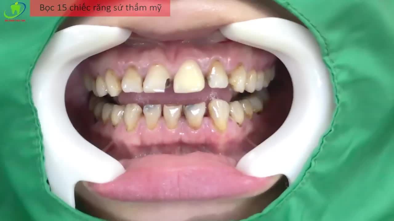BỌC RĂNG SỨ CỨU CÁNH HÀM RĂNG NHIỄM MÀU LÂU NĂM TẠI NHA KHOA THÙY ANH