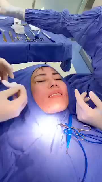 Quy trình đo vẽ Tạo má lúm + Tạo môi tim cho nữ khách hàng tại Kangnam