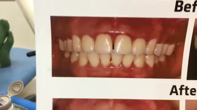 Ca gắn răng sứ thẩm mỹ khắc phục răng thưa, việm lợi cho khách hàng tại Nha Khoa Thuỳ Anh.