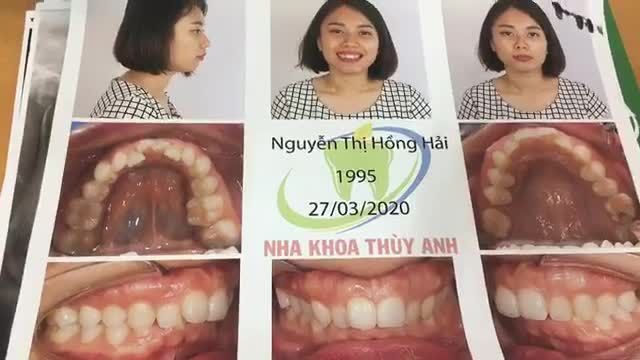 Gắn mắc cài tại Nhà Khoa Thuỳ Anh