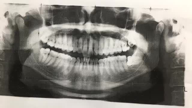 Nhổ răng khôn tại Nha Khoa Thuỳ Anh.