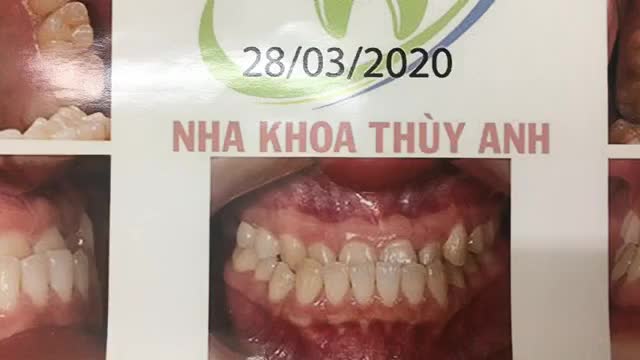 Gắn mắc cài cho bạn Tú Anh tại Nha Khoa Thuỳ Anh.