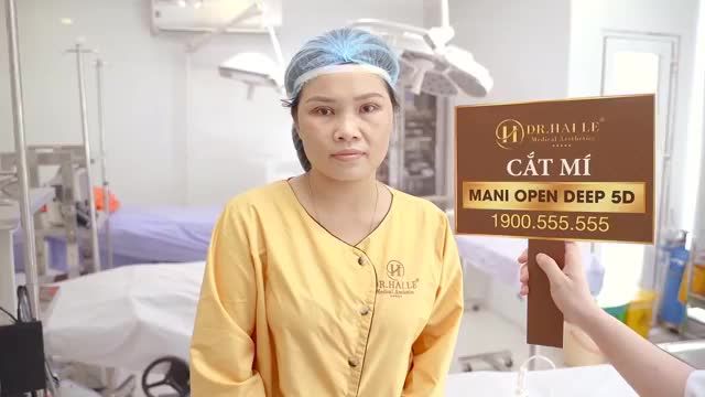 Kết quả cắt mí Mani Open Deep 5D vừa thực hiện xong, hai mí rõ nét, khuôn mắt tươi trẻ.