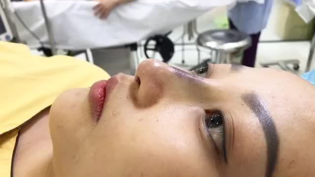 Kết quả nâng mũi vừa thực hiện xong, có kết hợp mài gồ nên có phần hơi tím nhưng dáng mũi của khách hàng đã được cải thiện đến 90%.